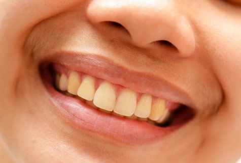 How to remove yellowness on teeth